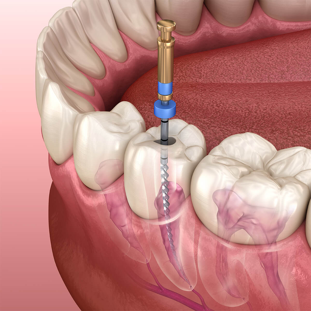 Endodontic Retreatment Service in San Antonio Area