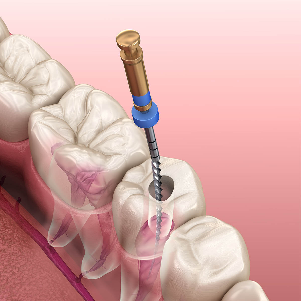 Root Canal Infection in San Antonio TX Area