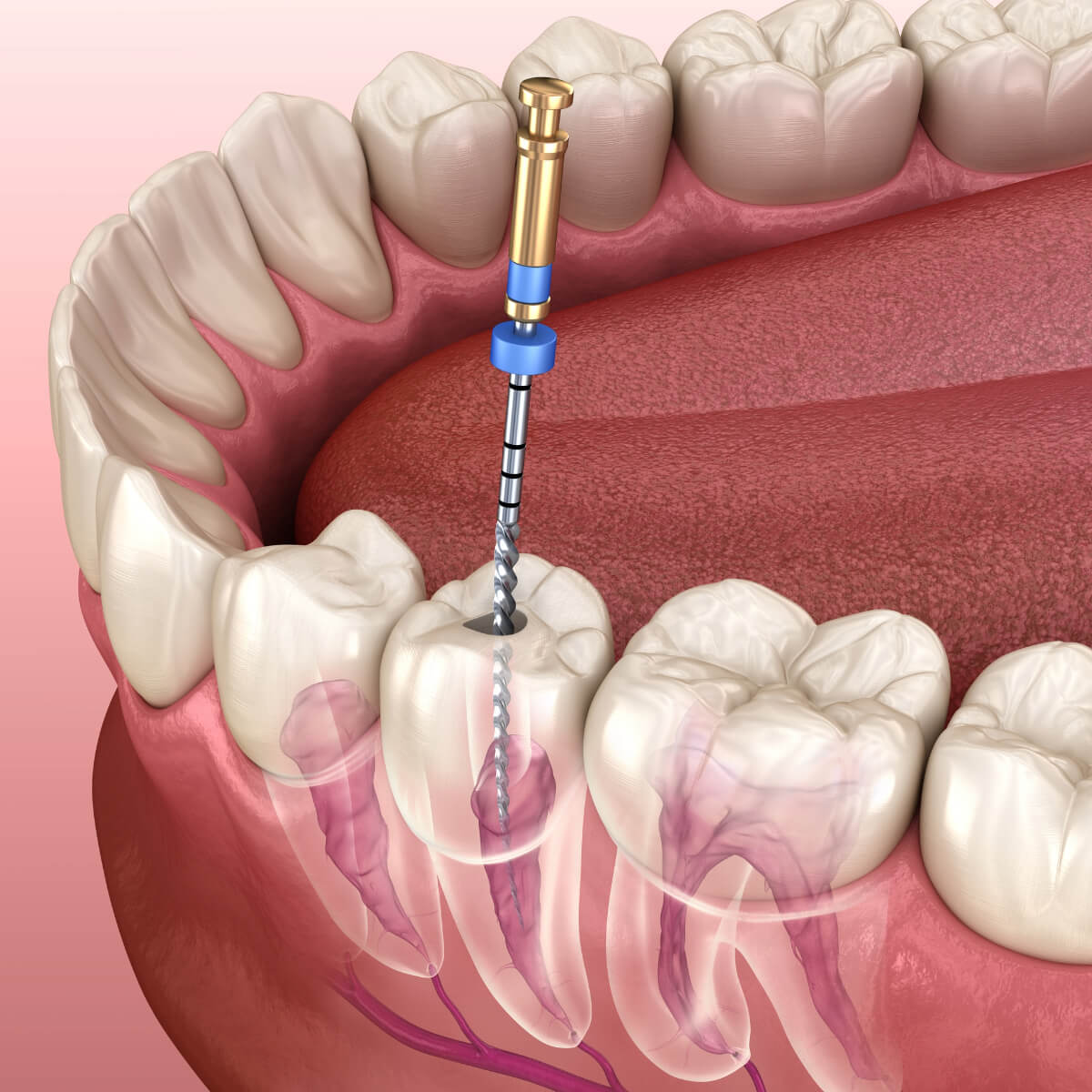 Root Canal in San Antonio TX