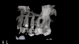 X-ray of patient teeth